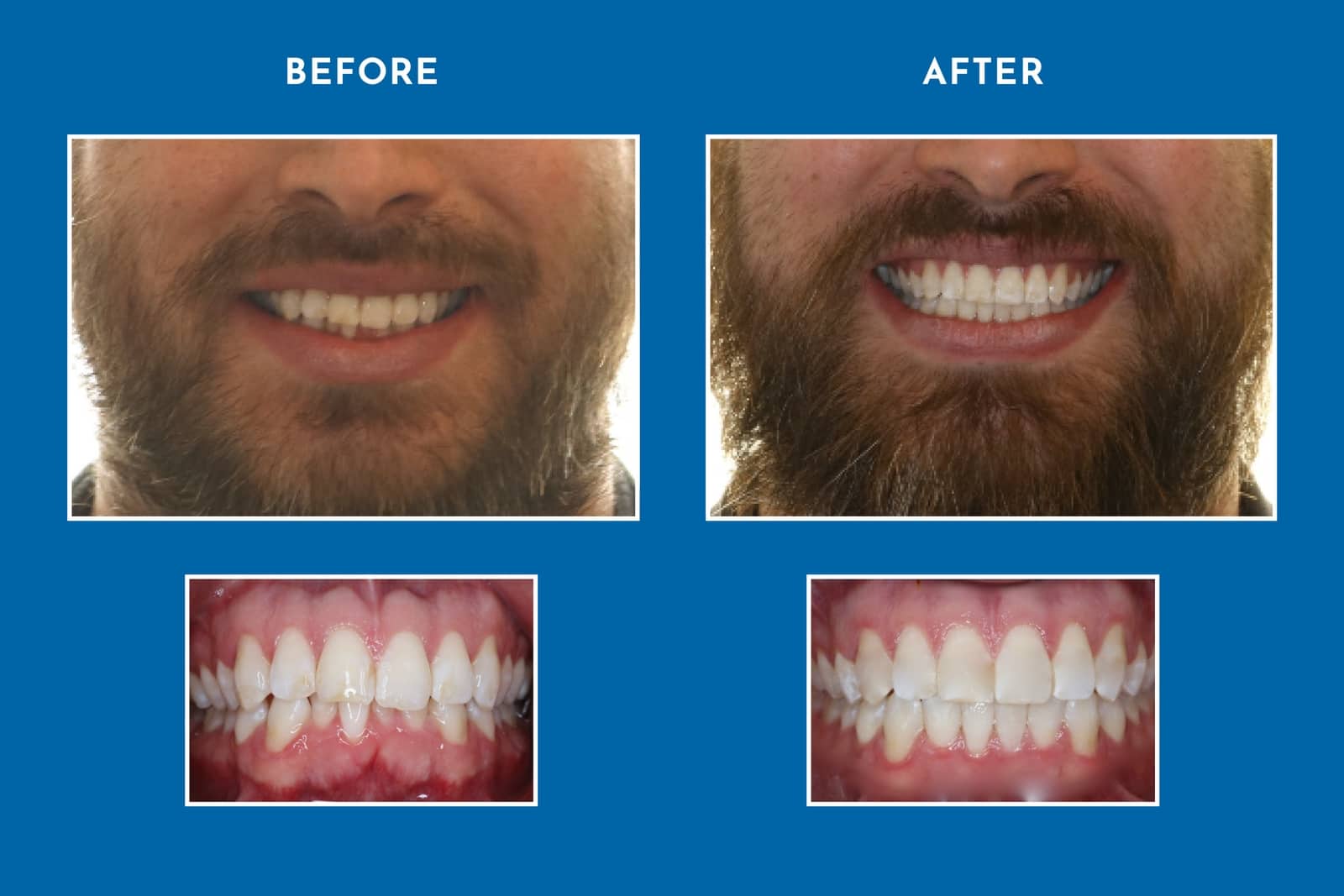 Orthodontics on Queen Invisalign & Braces in The Beach, Toronto